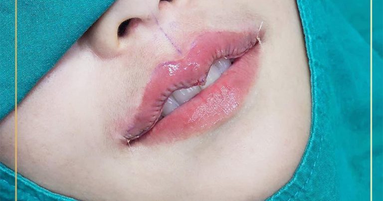 ทำปากกระจับพักฟื้นกี่วัน – วิธีการ, เทคนิค, และคำแนะนำ