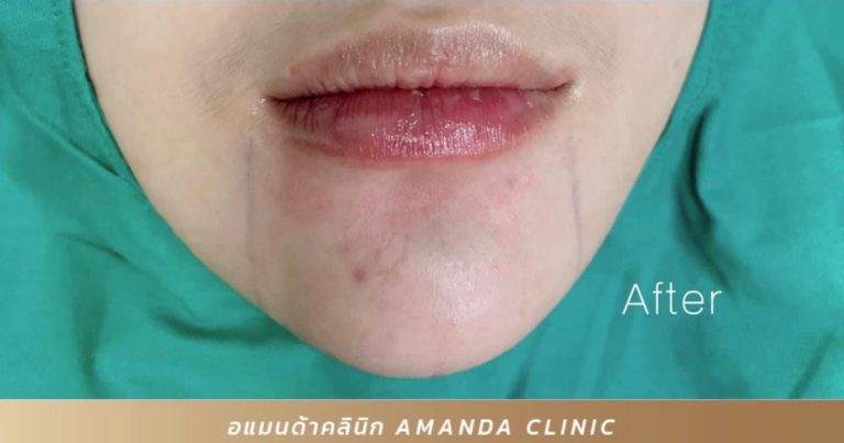 เสริมคางในกับเสริมคางนอก: ข้อแตกต่างและการดูแลรักษา