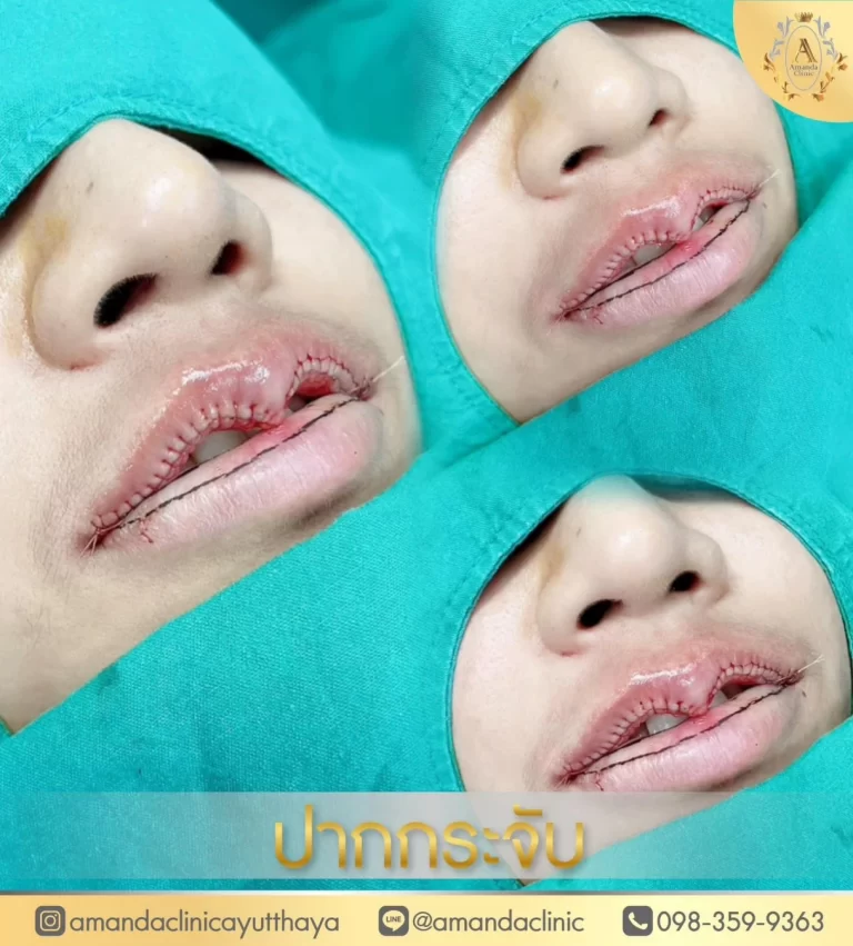 การตัดปากกระจับ: กระบวนการเสริมความงามทันสมัย