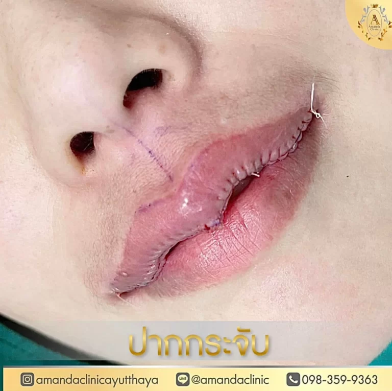เคล็ดลับการทำทรงปากกระจับเสริมความงาม: น่ารักและมั่นใจด้วยริมฝีปากสวยงาม