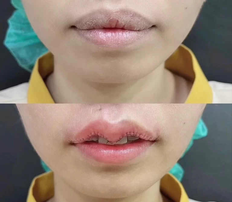 “ปากกระจับผู้ชาย”: การเสริมโหวงเฮ้งสำหรับความงามของผู้ชาย