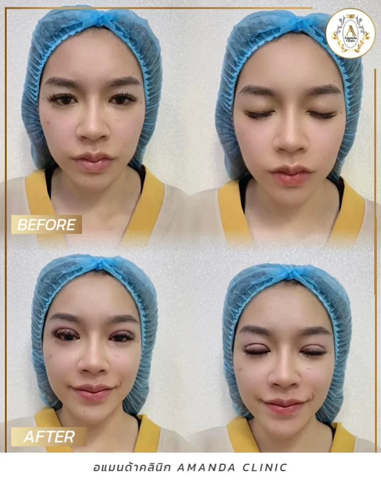 วิธีดูแลหลังทำตา 2 ชั้น