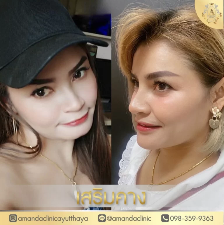 เสริมคางหน้ากลม: ทำความรู้จักกับวิธีและขั้นตอน!