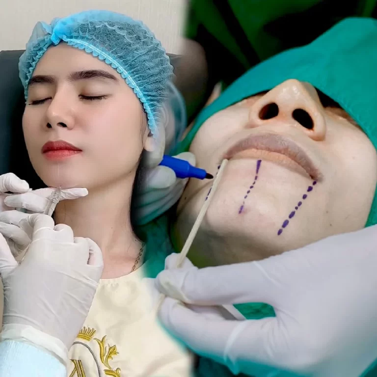 ฉีดฟิลเลอร์คางและเสริมคาง